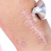 Kem trị sẹo lồi Ticarlox 10g - Hình ảnh 2