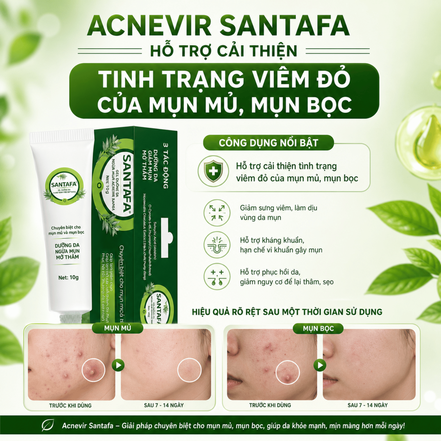 ACNEVIR SANTAFA – Kem Chấm Mụn Viêm, Mụn Bọc, Mụn Mủ Hiệu Quả Tuyp 10g - Ảnh 4